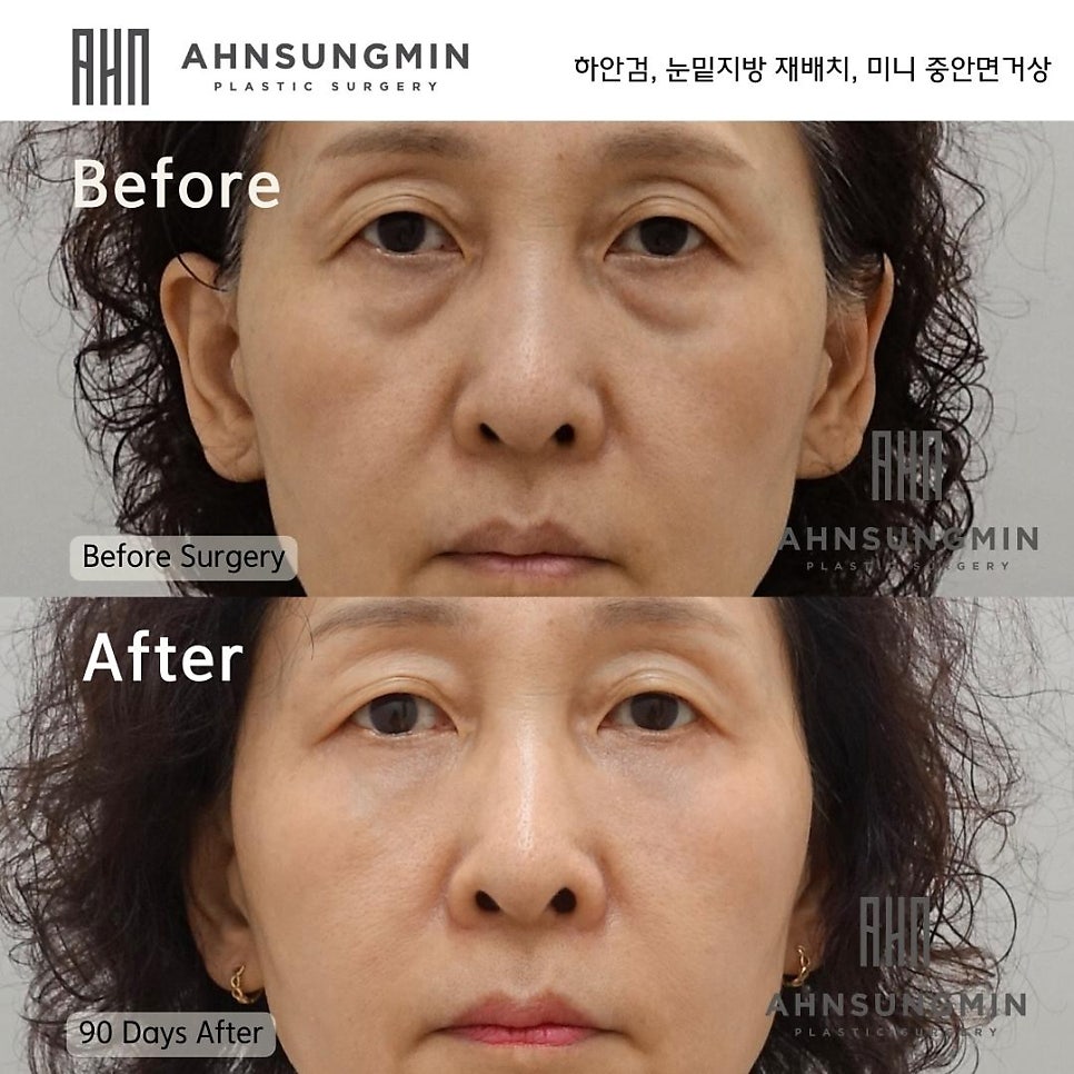 하안검 눈밑지방재배치 수술시 미니 중안면 거상이 필요한 이유 성형외과 전문의안성민원장님 관련 이미지 2