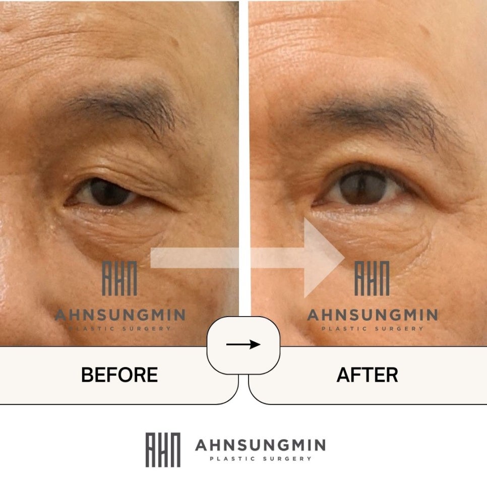 중년남성의 상안검 수술 회복기간은 어떻게 될까요? 관련 이미지 3