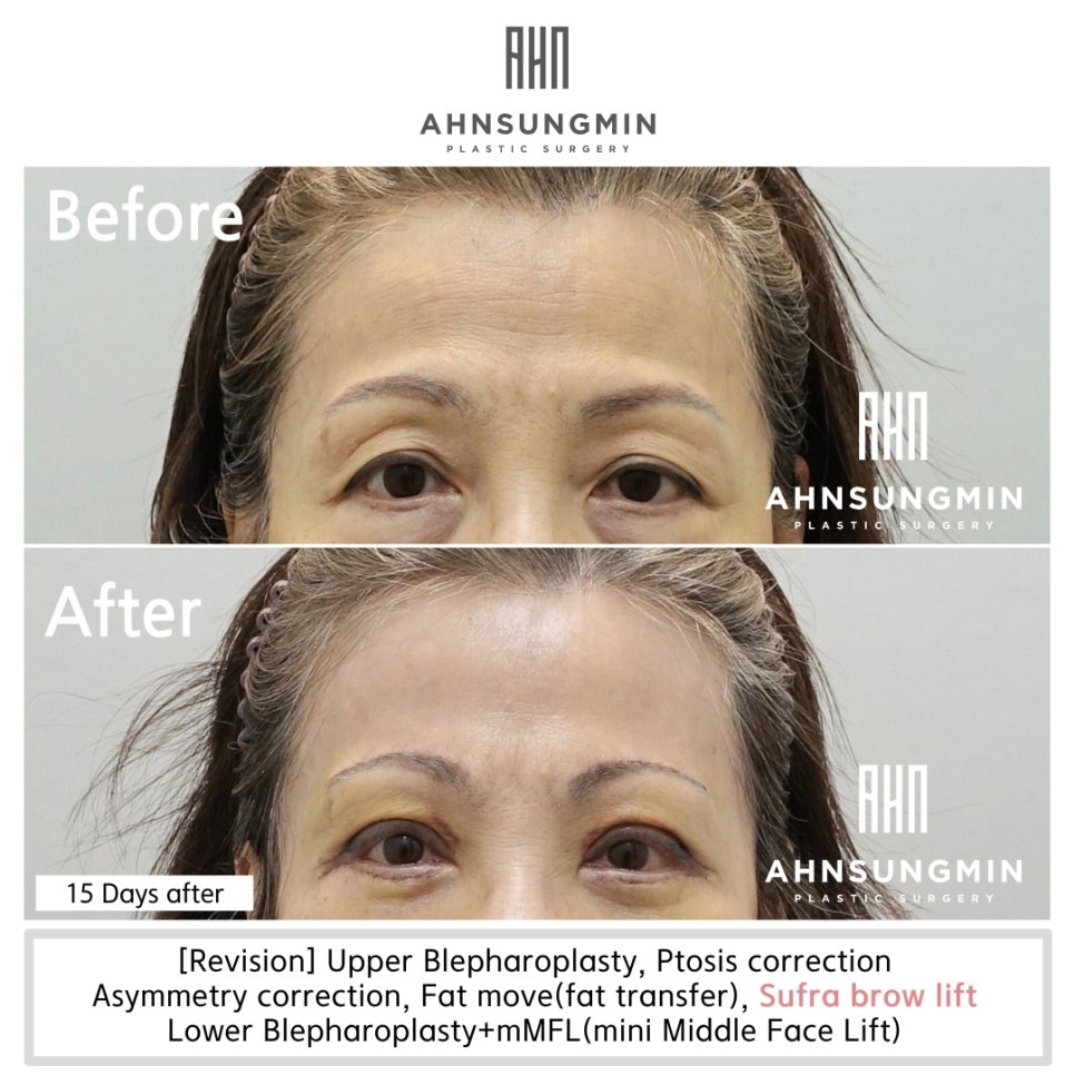 눈썹거상수술,눈썹상거상 수술이 필요한 이유 [성형외과 전문의 안성민 대표원장] 관련 이미지 4