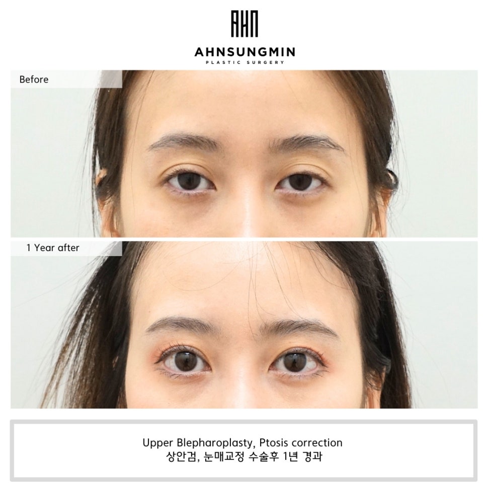 쌍꺼풀이 풀리는 이유와 교정 방법 [성형외과 전문의 안성민] 관련 이미지 1