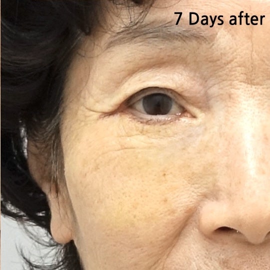 70대 여성 눈 밑 하안검 수술 회복 리얼 후기 관련 이미지 5