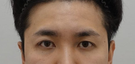 남자 돌출 눈 짝짝이 교정 잘하는 곳, 안검하수 짝짝이 안성민성형외과 관련 이미지 6