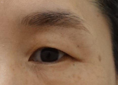 상안검 수술과 뒷트임 수술을 함께 진행하는 이유, 뒷트임의 중요성 관련 이미지 3