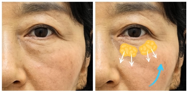 하안검 지방재배치 재수술, 정말 가능한가요? 관련 이미지 3