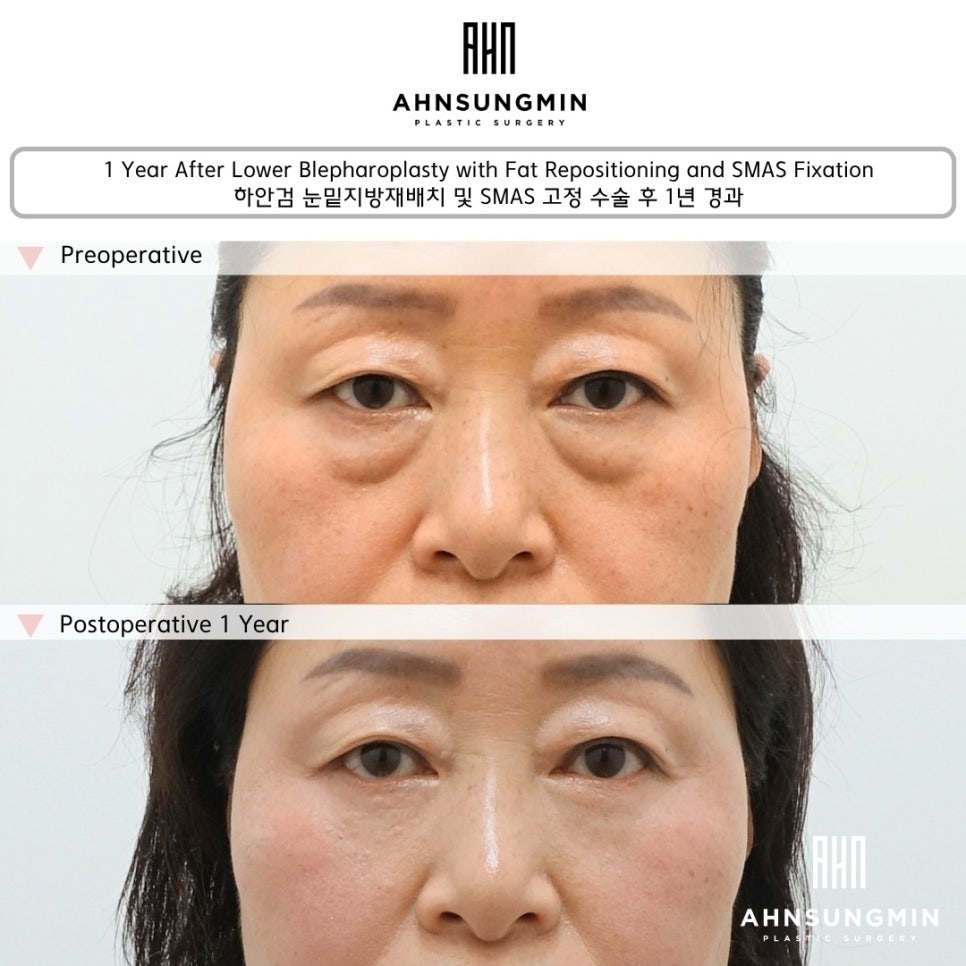 하안검 눈밑지방재배치 수술 1년 경과, 결과는 어떻게 달라질까? 관련 이미지 1