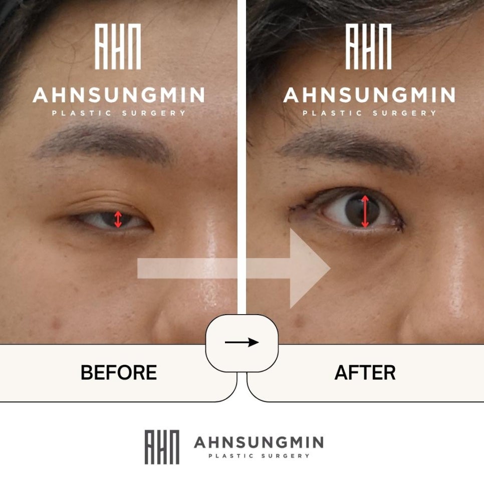 안검하수 자가진단, 뮬러근,눈매교정 수술이 필요한 이유 관련 이미지 2