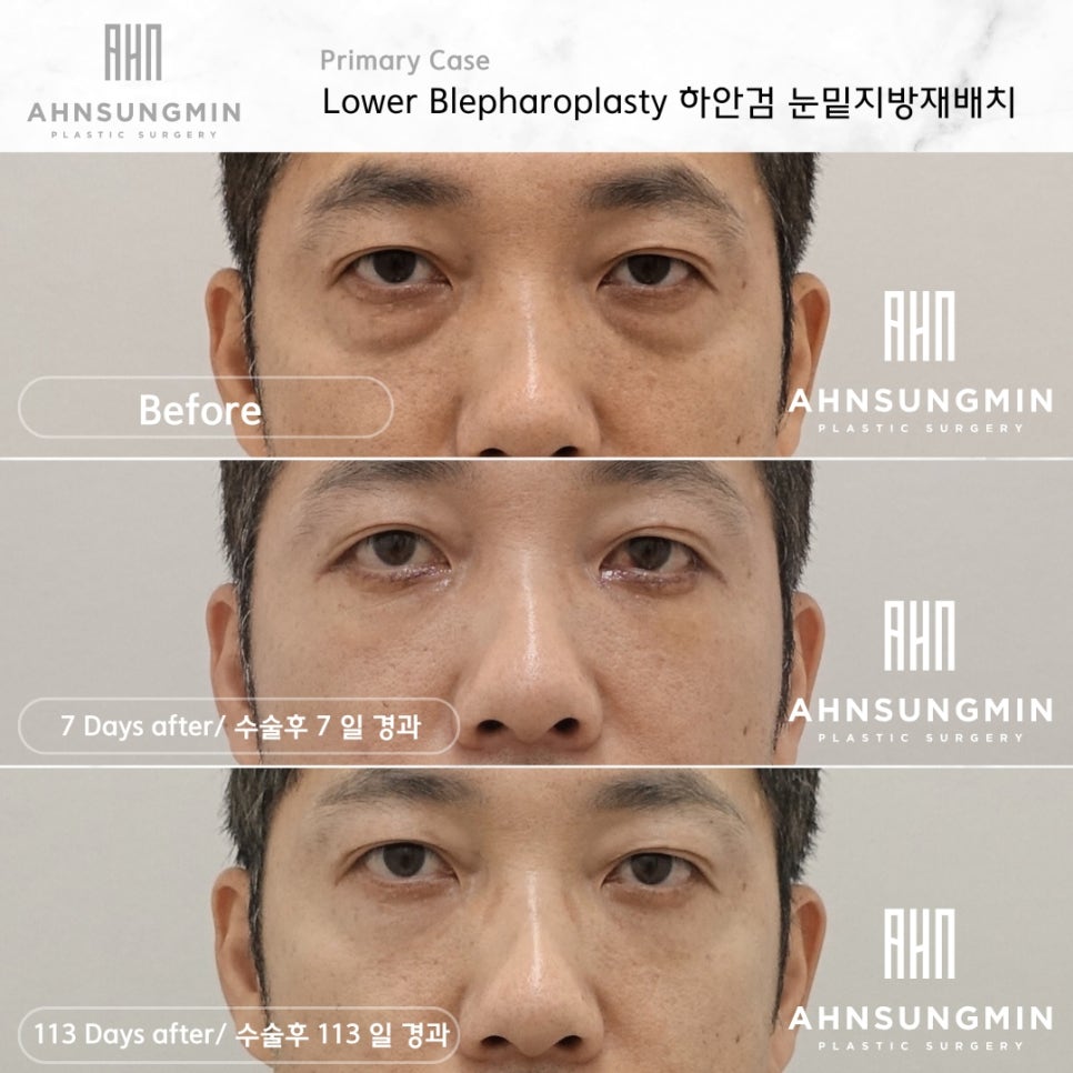 중년 남성 눈밑 지방재배치 잘하는 병원, 안성민 성형외과 관련 이미지 2