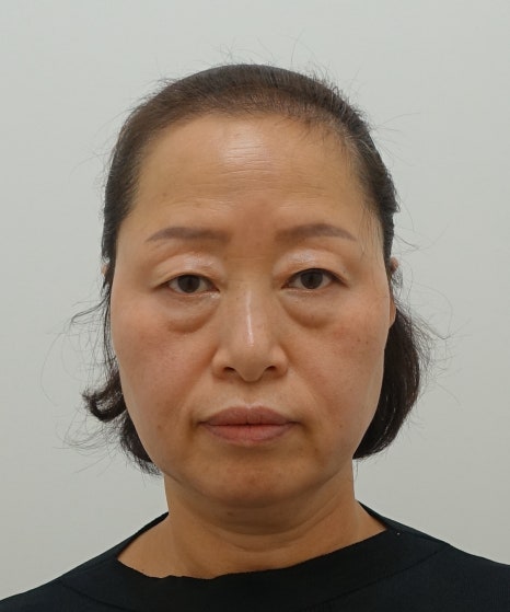 중년 눈 밑 지방 재배치 수술 후 1년 경과 [성형외과 전문의 안성민] 관련 이미지 3