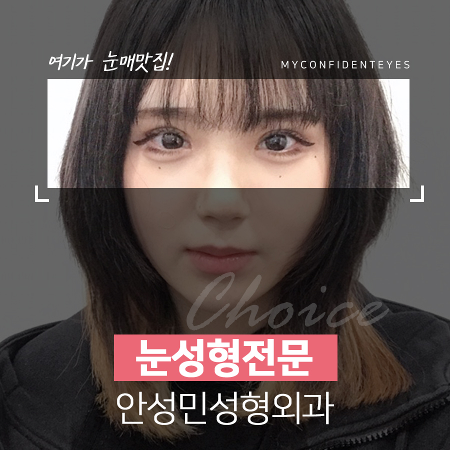 [잠실동성형외과] 눈매맛집!잠실성형외과 관련 이미지 1