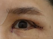 상안검 수술과 뒷트임 수술을 함께 진행하는 이유, 뒷트임의 중요성 관련 이미지 4