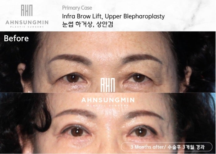눈썹하거상 후 눈썹 모양, 눈썹하거상 부작용을 겪지 않으려면?잠실성형외과 관련 이미지 2