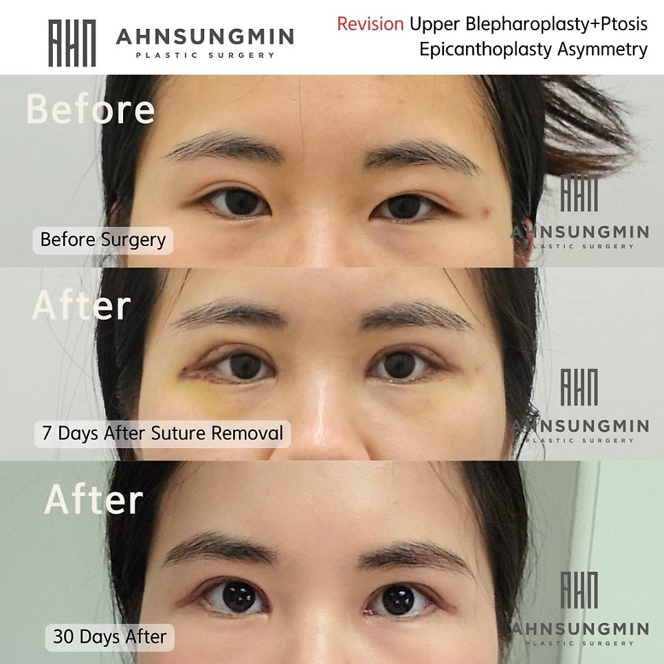 눈재수술이 적절한 시기는 언제일까요? 재수술전 쌍꺼풀 테이프 사용을 해도될까요? 관련 이미지 4