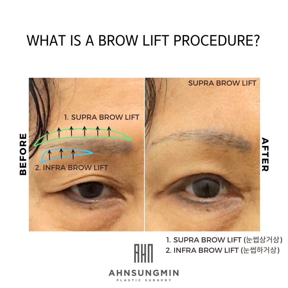 눈썹거상수술,눈썹상거상 수술이 필요한 이유 [성형외과 전문의 안성민 대표원장] 관련 이미지 2