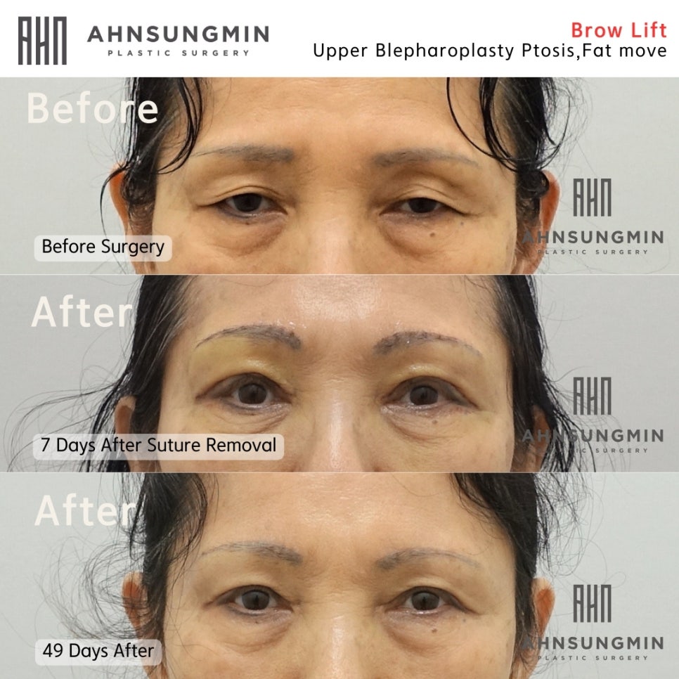 중년여성의 눈꺼짐 해결방법은? 관련 이미지 2