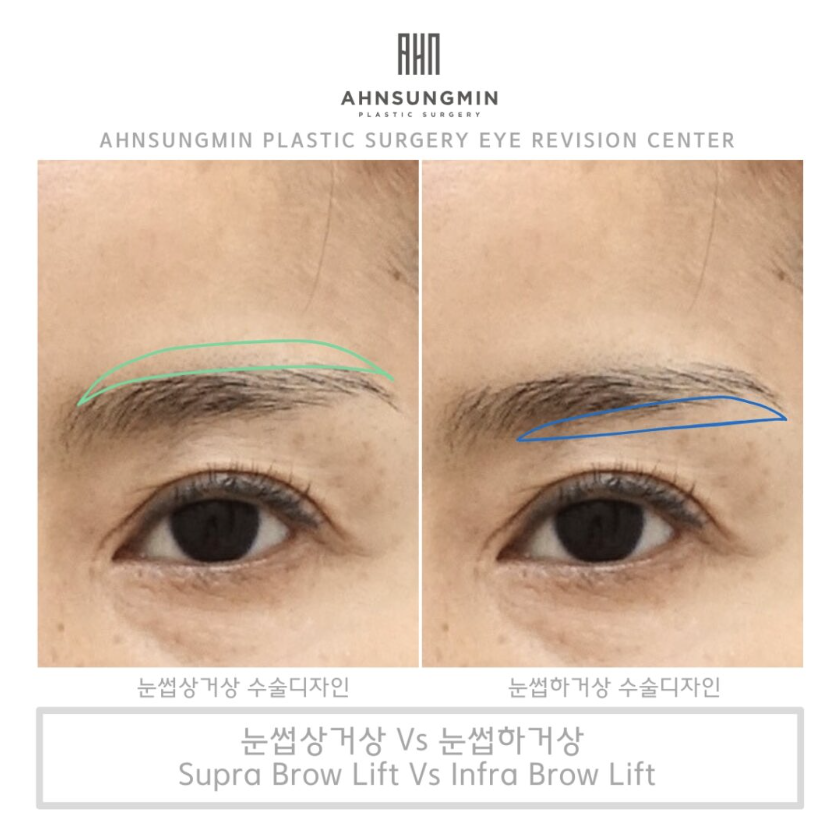 눈꺼풀 처짐의 원인과 눈썹 거상 수술이 필요한 이유 [성형외과 전문의 안성민] 관련 이미지 3