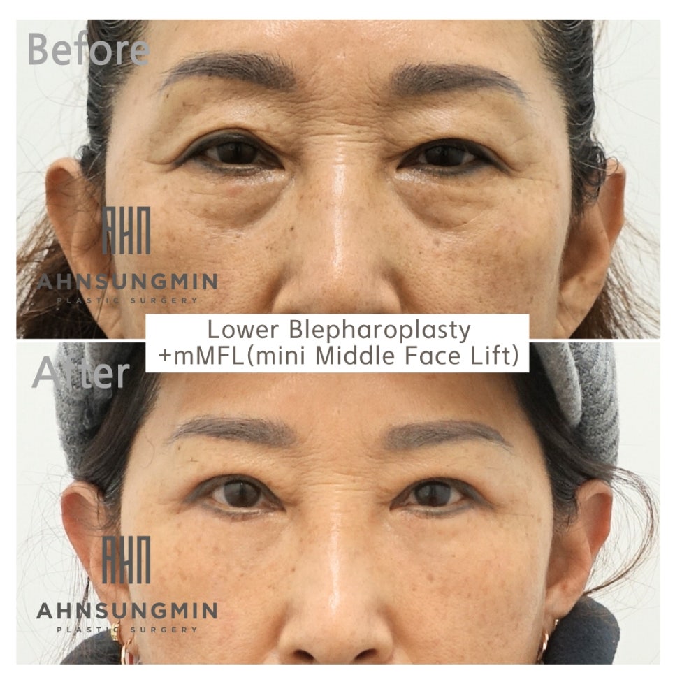 중년 성형수술을 받는 경우 혈압 관리는 매우 중요합니다. 관련 이미지 2