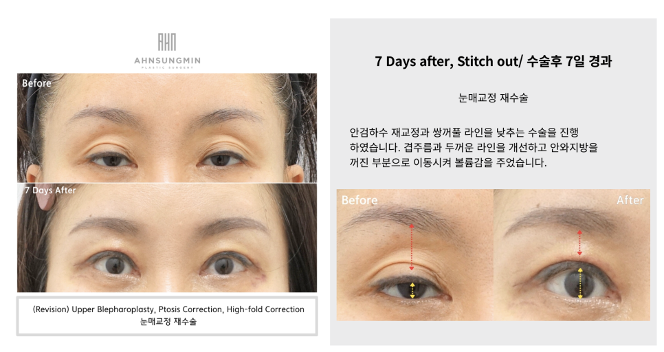 중년 눈 재수술 근본적인 문제 해결 맞춤 재수술 관련 이미지 5