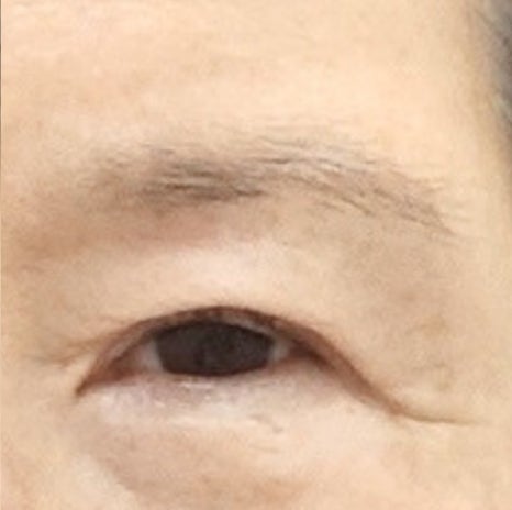 눈썹 거상 수술 흉터와 회복 과정 관련 이미지 3