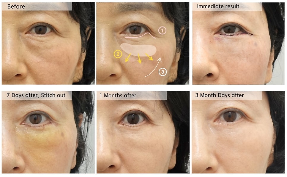 나이대별 눈밑지방재배치 수술 전후 사진 비교 관련 이미지 5