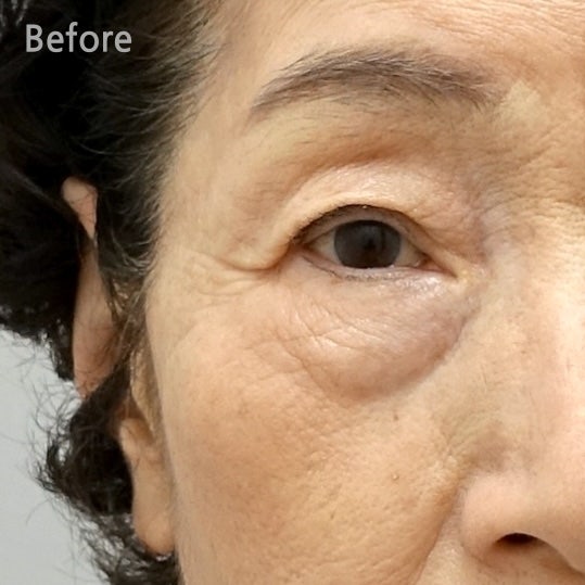 70대 여성 눈 밑 하안검 수술 회복 리얼 후기 관련 이미지 2
