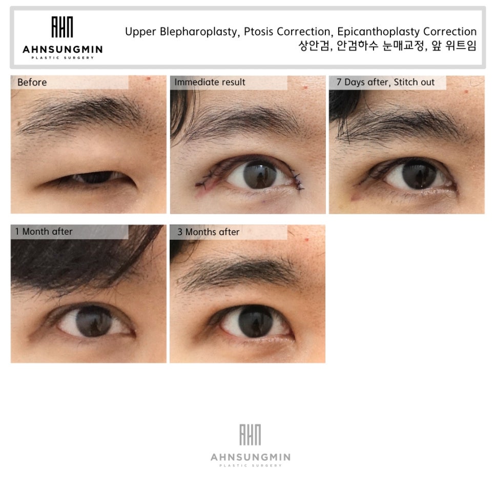 20대 중증 안검하수 수술 후 3개월 경과 관련 이미지 5