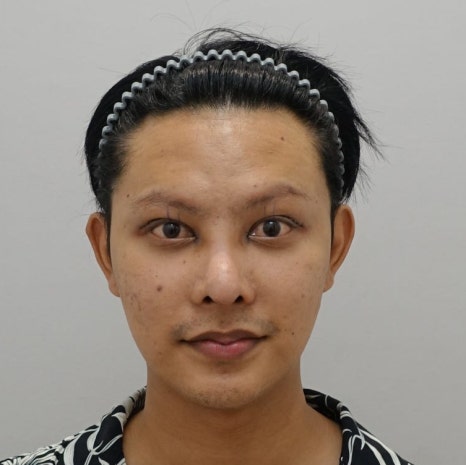 느끼한 남자 눈 무쌍이 되고 싶어요. 두꺼운 쌍꺼풀 낮추기 관련 이미지 8