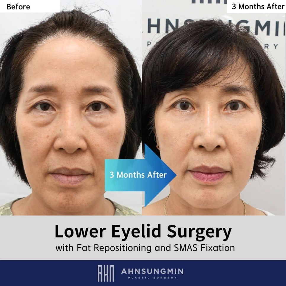 Lower Eyelid Surgery Recovery Process: How Natural Does It Actually Become? image 2