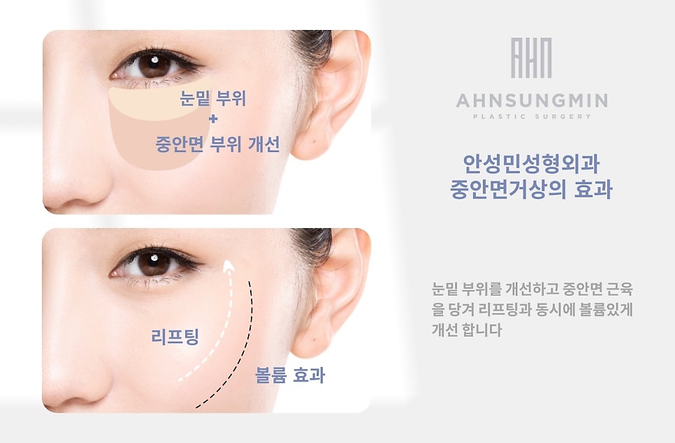 하안검 수술과 중안면 거상의 모든 것 관련 이미지 6
