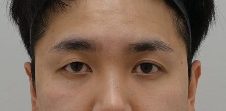 남자 돌출 눈 짝짝이 교정 잘하는 곳, 안검하수 짝짝이 안성민성형외과 관련 이미지 5