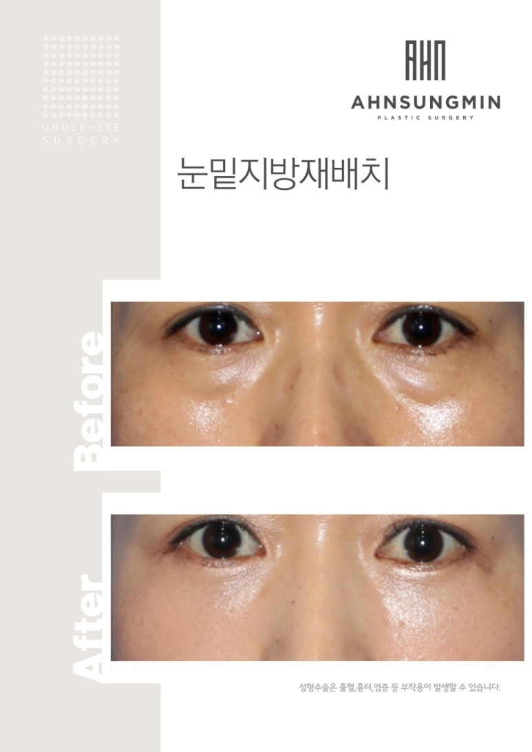 눈밑지방재배치 관련 이미지 2
