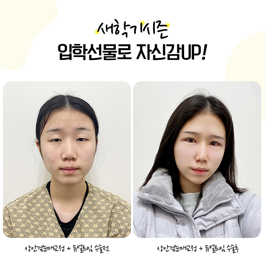 [잠실동성형외과] 새학기 시즌! 학생들이 제일 받고 싶어하는 입.학.선.물! 콤플렉스가있는 자녀에게 자신감을 선물해주세요 / 잠실성형외과 관련 이미지 1