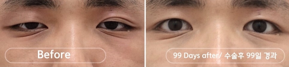 안검하수 짝짝이 교정이 어려운 이유 관련 이미지 2