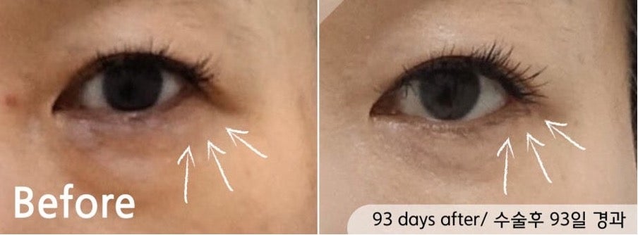 트리플 트임 뒤트임,뒤내림,밑내림 어떻게 다를까? 관련 이미지 3