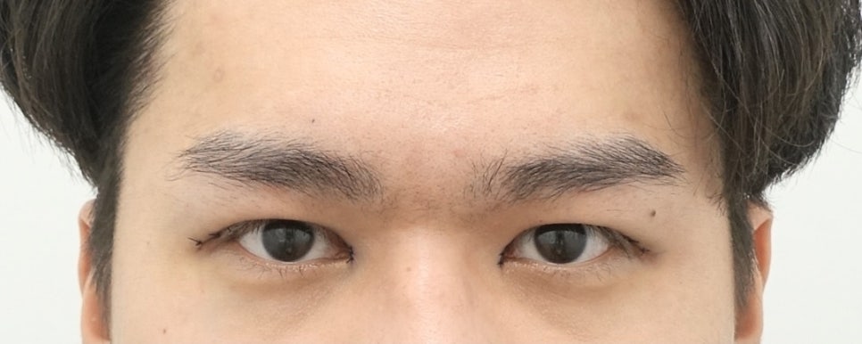 나이대별 상안검 수술 전후, 성형외과전문의 안성민 관련 이미지 6