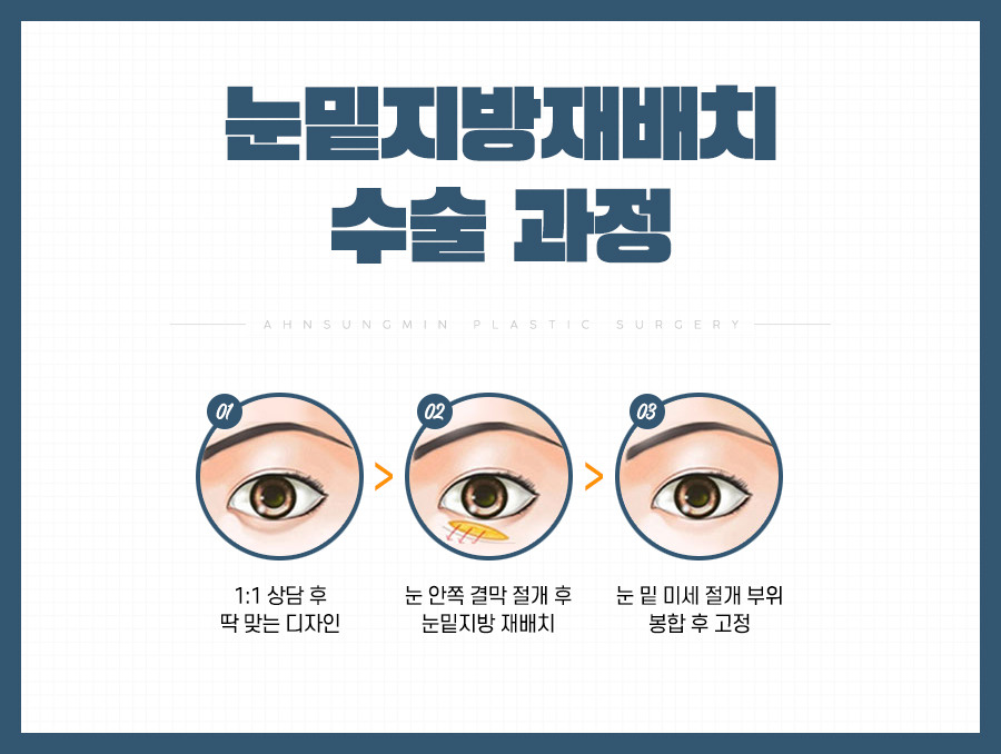 안성민성형외과, 볼록한 눈밑 해결될까? 관련 이미지 5