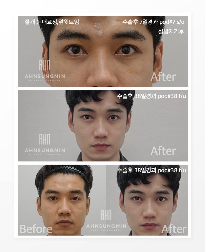 쌍꺼풀수술 나에게 맞는 눈모양으로 관련 이미지 6