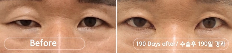 안검하수 짝짝이 교정이 어려운 이유 관련 이미지 3