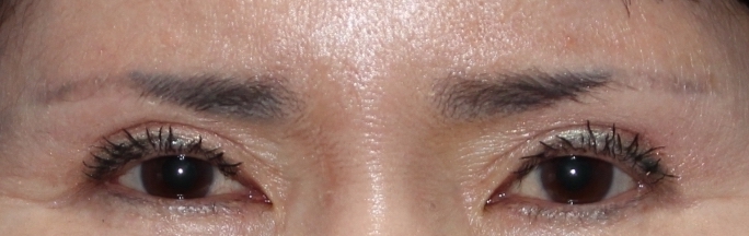 눈꺼풀 처짐의 원인과 눈썹 거상 수술이 필요한 이유 [성형외과 전문의 안성민] 관련 이미지 2