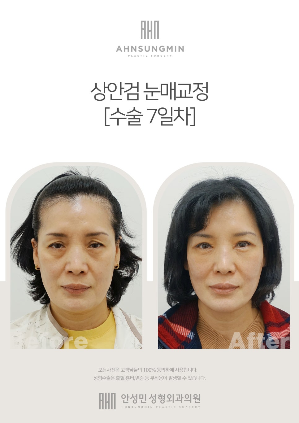 상안검눈매교정(안검하수교정) 관련 이미지 1