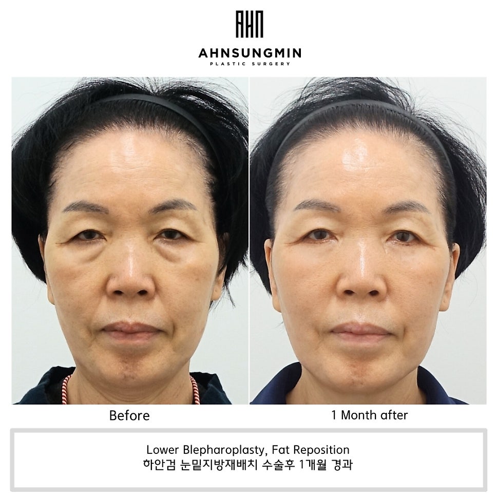 하안검 수술 시 SMAS 층 중안면 리프팅이 필요한 이유 관련 이미지 2