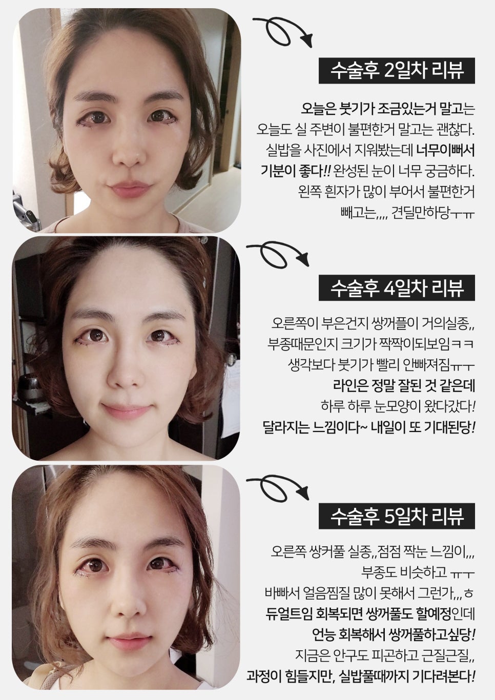 [잠실동성형외과] 듀얼트임 고객님의 리얼후기! 성형후기! 뚜렷한 눈매를 원한다면? 잠실 안성민성형외과! 관련 이미지 3