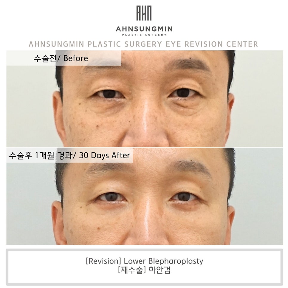 중년 하안검, 눈 밑 지방재배치 재수술 근본적인 원인을 해결하다. 관련 이미지 1