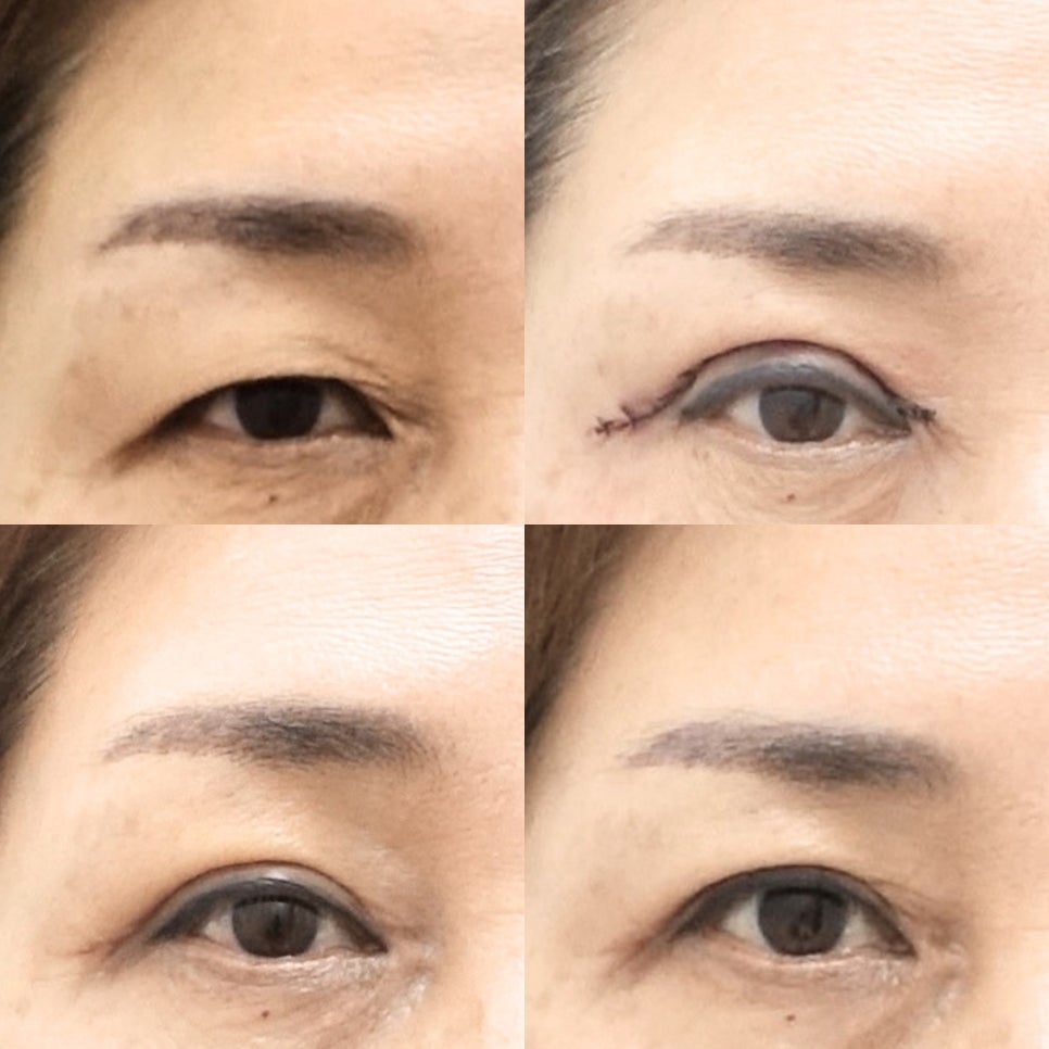 나이대별 상안검 수술 전후, 성형외과전문의 안성민 관련 이미지 1