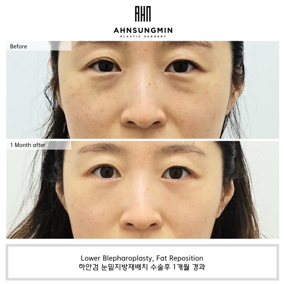 나이대별 눈밑지방재배치 수술 전후 사진 비교 관련 이미지 2