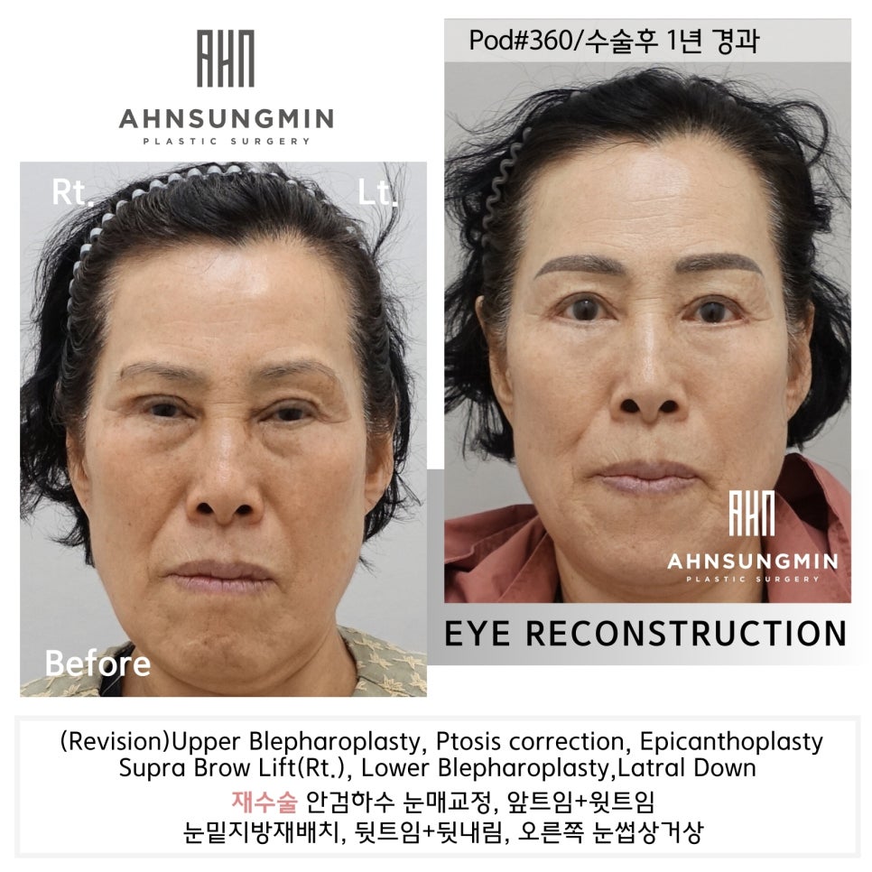 눈 재수술 과정 [성형외과 전문의 안성민] 관련 이미지 2