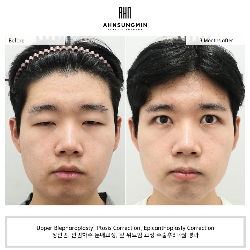 20대 중증 안검하수 수술 후 3개월 경과 관련 이미지 2
