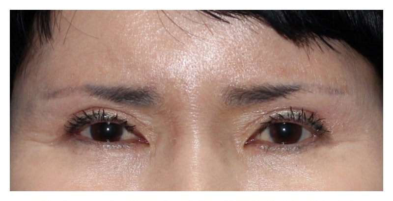 눈재수술 눈매교정재수술 트임 재수술 눈썹상거상 관련 이미지 2