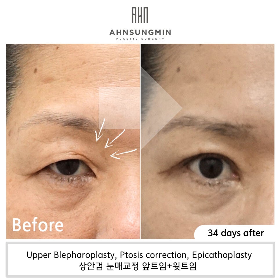 중년 눈매교정 수술 후 1개월 경과 관련 이미지 3