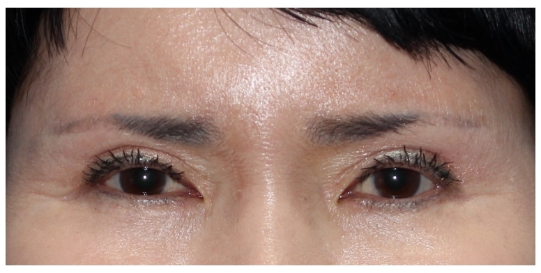 남자도 눈썹 거상 수술을 할 수 있을까요? 관련 이미지 1