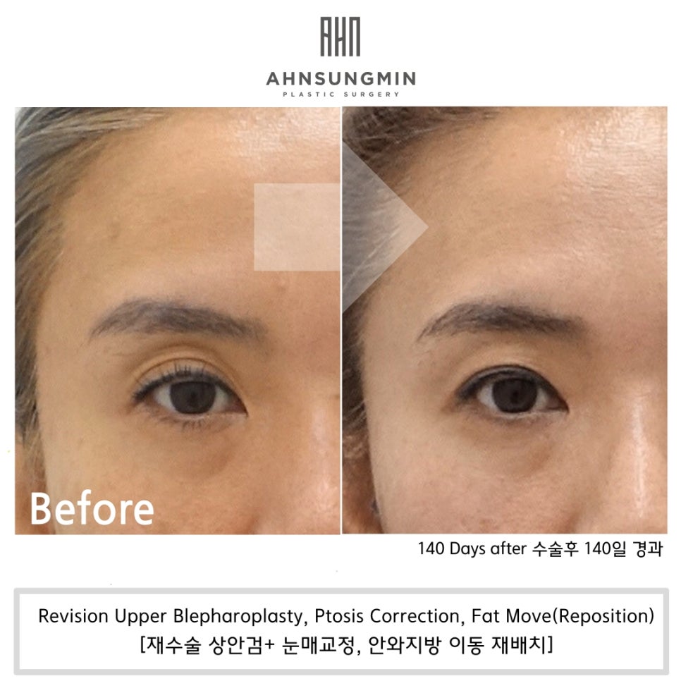 꺼진 눈 나이 들어 보이는 이유, 꺼진 눈 해결 방법 관련 이미지 5